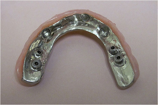 The image shows a single upper front tooth prosthetic with visible screws and metal attachments, set against a plain background.