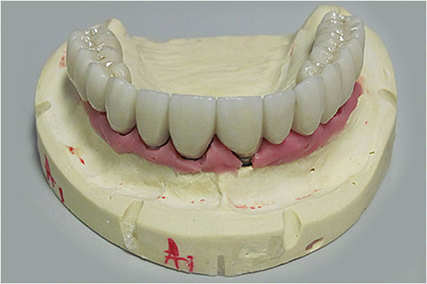 A dental mold with a set of upper dentures featuring teeth and gums.