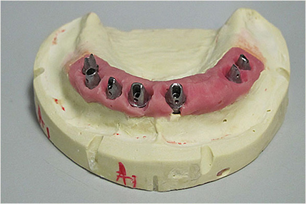 The image displays a plastic model of an upper dentition with teeth and gums, featuring a set of artificial teeth with visible screws for attachment, placed on a base that resembles a jaw structure.