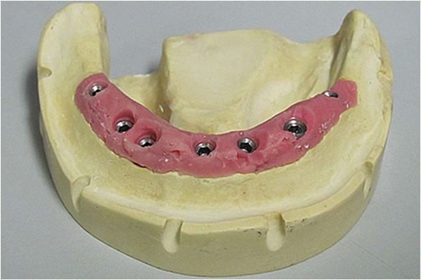 The image shows a dental model with an upper denture base, featuring artificial teeth and gums, with a pinkish-red area indicating a cavity or missing tooth space, and a lower denture base with a similar design, including a metal framework for retention and support.