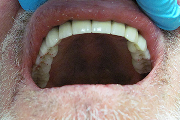The image shows a person's mouth with an open toothless smile, revealing a dental implant on the front left side, and the person appears to be wearing a blue surgical mask.