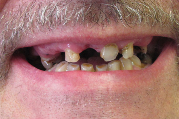 The image shows a close-up view of a person's face with a large smile revealing teeth with visible fillings, and there are no visible texts on the image.