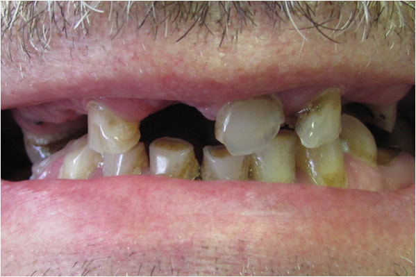 The image shows a close-up view of a person's mouth with a set of dentures, displaying yellowed teeth and gums, indicating poor oral hygiene.