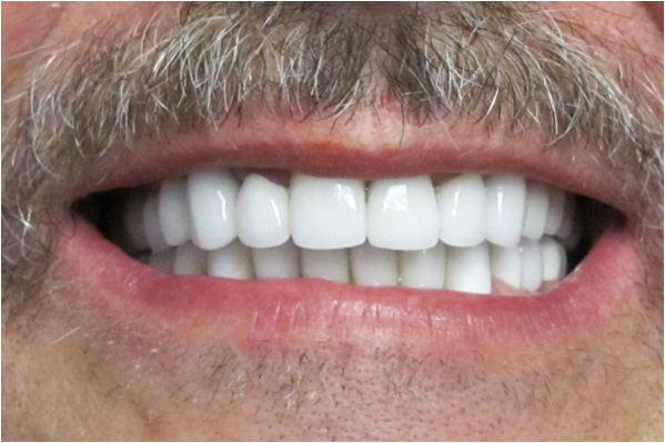 The image shows a close-up of a person's face with a large smile revealing white teeth, and they have a mustache.