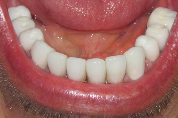 An extreme close-up of an open mouth revealing white teeth and a red tongue, with a blurred background that suggests a person's face.