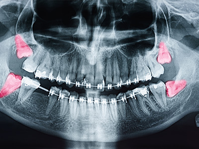 The image displays an X-ray of a human head with visible dental implants and surgical pins, showing the internal structure of the mouth and teeth area.