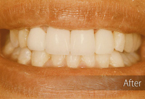 The image shows a close-up view of a person's teeth with a bright smile, highlighting dental work such as veneers or cosmetic dentistry.