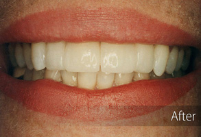 The image shows a person with a wide smile displaying straight white teeth, which appears to be a before-and-after photo of a dental treatment or cosmetic procedure.