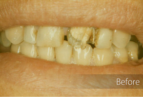 The image shows a close-up of a person's mouth during a dental procedure, with teeth being prepared for implants, before and after the treatment.