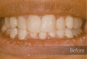The image shows a close-up of a person's teeth with an overlay text 'Before' and an arrow pointing from the top left to the bottom right, indicating a transformation or change in dental appearance.