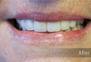 The image shows a close-up of a person's face with a smiling expression, featuring teeth whitening results after treatment.