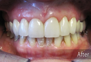 The image shows a close-up of a person's mouth with teeth that have been whitened, featuring a before-and-after comparison with noticeable improvement in brightness and coloration of the teeth.