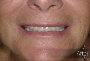 The image shows a close-up view of an individual's face with a smile, emphasizing their teeth and facial features.