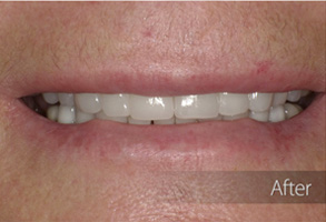 The image shows a close-up of a person's face with a wide smile, revealing white teeth and gums.