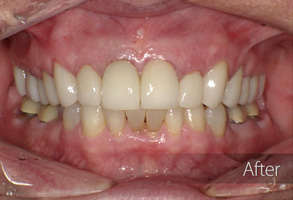 The image shows a close-up view of an individual's teeth before and after a cosmetic dental treatment, with a focus on the transformation of the patient's smile.