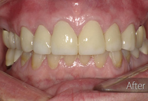 The image shows a close-up view of a person's mouth with teeth undergoing cosmetic dental treatment, possibly involving veneers or crowns, as evidenced by the altered appearance and presence of dental tools.