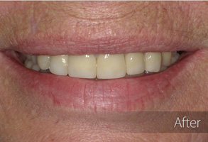 The image shows a close-up of a person's face with an enhanced smile, featuring cosmetic dental work such as teeth whitening and possibly veneers or implants, with a visible lip enhancement.