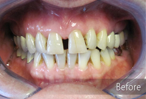 The image shows a close-up view of an individual's mouth with teeth that have been enhanced with cosmetic dental work, specifically veneers, which are now missing, revealing the natural teeth underneath.