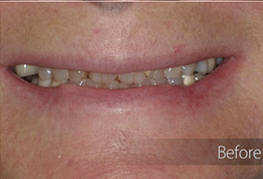 The image shows a person's face with an open mouth displaying teeth, and there appears to be a cosmetic dental procedure in progress, indicated by the text 'Before' suggesting a before-and-after comparison.