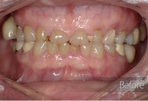 The image shows a close-up of an open mouth with teeth, revealing a dental implant on the lower left side and a pinkish oral cavity, possibly indicating a post-treatment or pre-treatment state before cosmetic dental work.