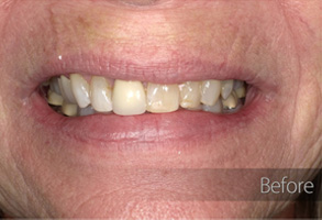 The image shows a close-up of an individual's face with a focus on teeth that have been whitened, displaying a bright smile.