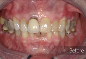 The image shows a close-up of a person's teeth with an overlay of a before-and-after comparison, indicating dental treatment improvement.