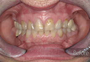 The image displays a close-up view of a person's mouth with teeth showing signs of discoloration and decay, emphasizing the importance of dental hygiene and care.