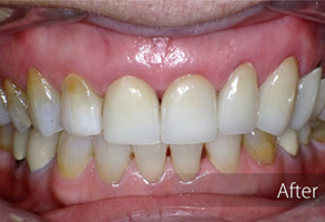 The image shows a close-up view of a person's teeth after a dental treatment, with visible signs of improvement such as whiter enamel and straightened alignment.