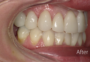 The image shows a close-up view of a person's mouth with a focus on dental work, specifically displaying a set of teeth with visible fillings and a partial denture.