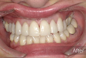The image shows a close-up view of a person's teeth after dental treatment, with an 'after' comparison to their natural teeth.