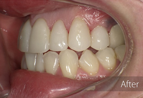 The image shows a close-up view of a person's teeth undergoing cosmetic dental treatment, with visible signs of wear and possible preparation for a veneer or other procedure.