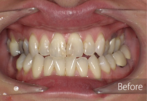 The image shows a close-up of a person's open mouth with teeth being straightened using braces, displaying an improvement from before when the teeth were misaligned.