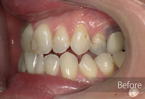 The image shows a close-up of a person's mouth with teeth and gums, before and after treatment, which includes a cleaning process, indicated by the presence of dental instruments and tools.
