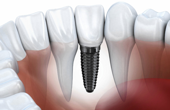 Dental Implants Boyton Beach