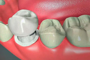 Why Do Dentists Recommend Dental Crowns in Boynton Beach?