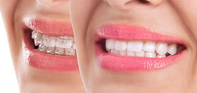 The image shows a woman with two different sets of teeth, displaying a before-and-after comparison likely related to dental treatments or cosmetic enhancements.