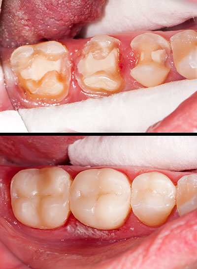 The image displays a dental restoration process with two photos  on the left, an open mouth showing a tooth with decay, and on the right, the same tooth after dental work, now restored with fillings and possibly other treatments.