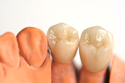 The image shows two rows of artificial teeth with visible imperfections, placed on either side of a set of human teeth with a healthy appearance.