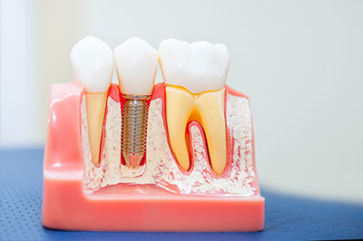 The image shows a clear plastic model of a human mouth with teeth, a tongue, and an implant, which appears to be a dental implant with a screw visible at the top.