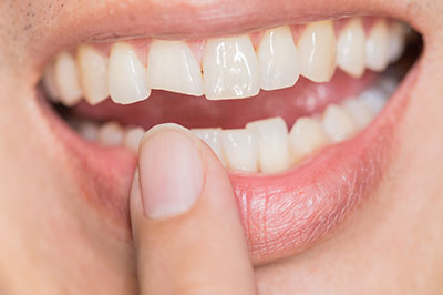 The image shows a person with a toothy smile holding their finger near their teeth, possibly examining them or making a point about dental hygiene.