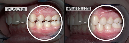 The image displays two photographs side by side showing a person s teeth with an overlay of text explaining  Malocclusion  and  Normal occlusion.