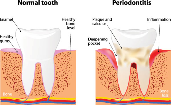 The image displays three stages of gum disease progression  normal tooth, healthy bone with some inflammation, and an advanced stage with severe bone loss and infection.