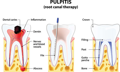 The image displays a diagrammatic illustration of a dental pulpitis with labeled parts, including the tooth, crown, canal therapy, and other components of dental anatomy, such as nerves, dentin, and fillings.