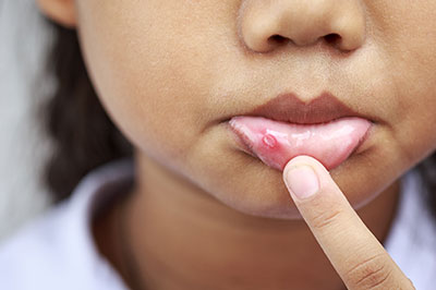 A young child with a pimple on their face, holding their finger against it.