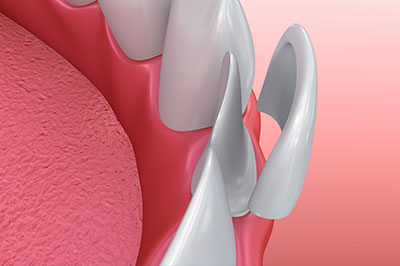 The image displays a close-up view of a human mouth with teeth and gums, featuring a dental implant with an attached screw visible on the top right side.