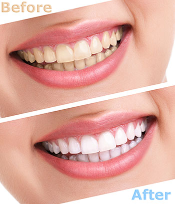 The image shows a before-and-after comparison of a person s teeth, with the  before  showing yellowed teeth and the  after  displaying bright white teeth, suggesting a transformation through dental treatment.