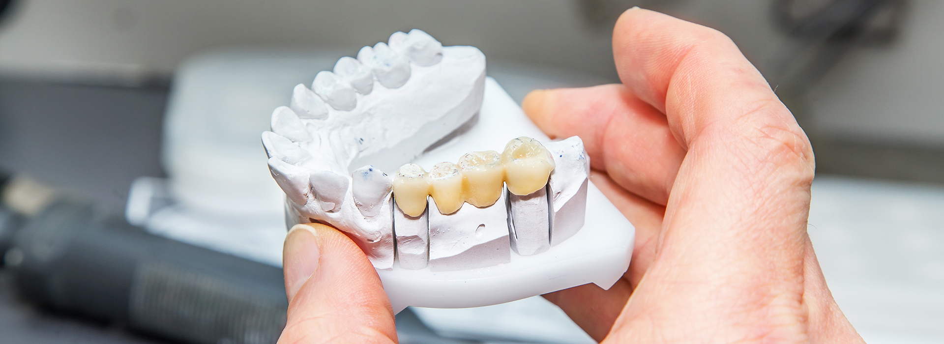 The image shows a person holding a 3D printed dental implant model with multiple teeth attached to it.