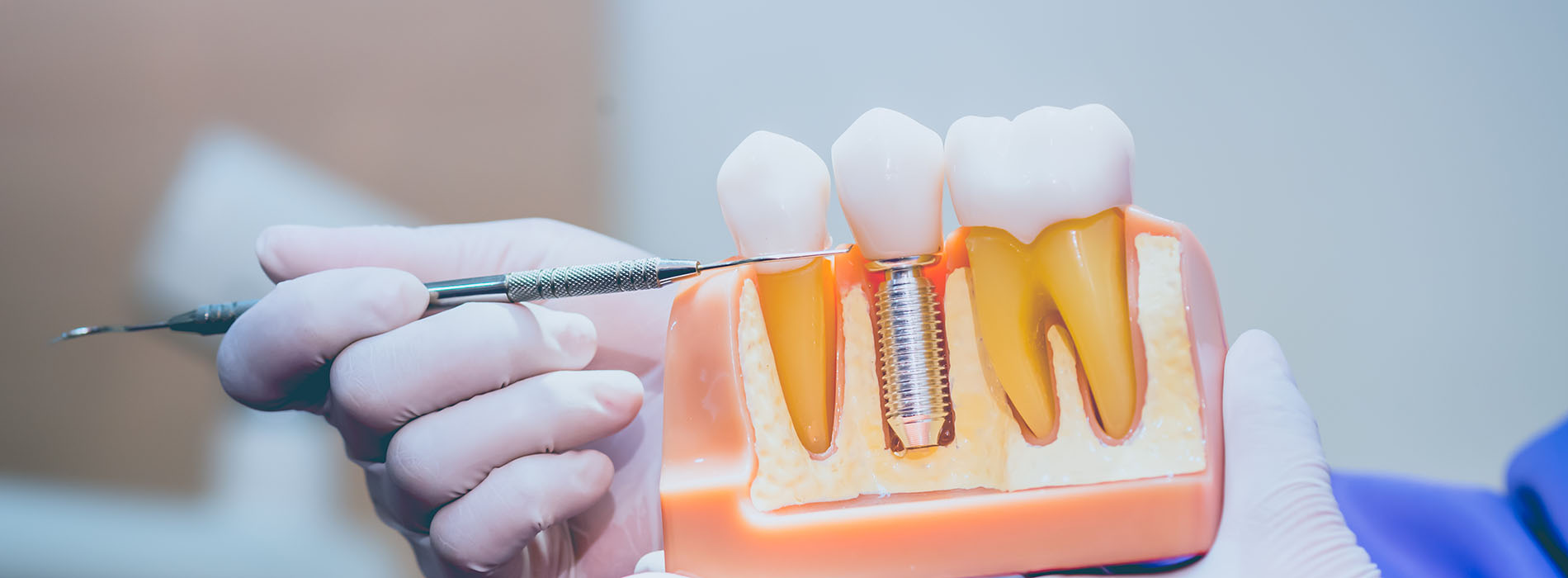 The image shows a person holding a dental implant with a screw in place, indicating a medical or dental setting.